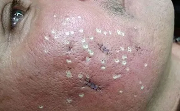 詢問台南除痘疤的醫美