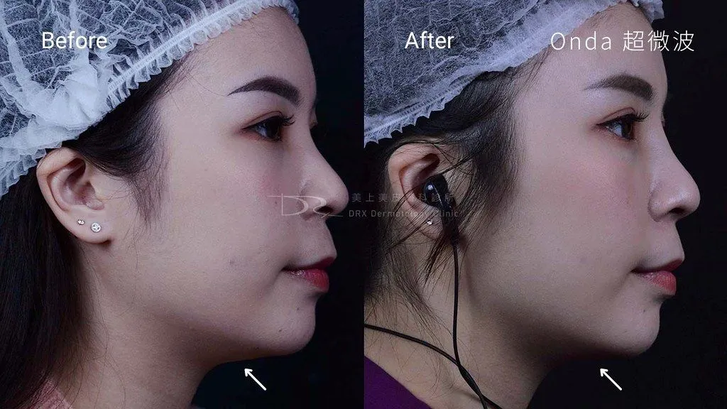 醫美瘦臉哪個項目好？