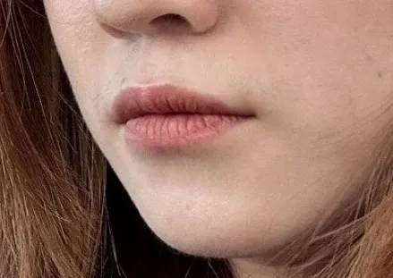 #分享 玻尿酸豐唇GET超性感嘴唇💋