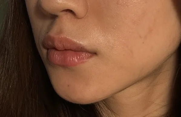 #分享 玻尿酸豐唇GET超性感嘴唇💋