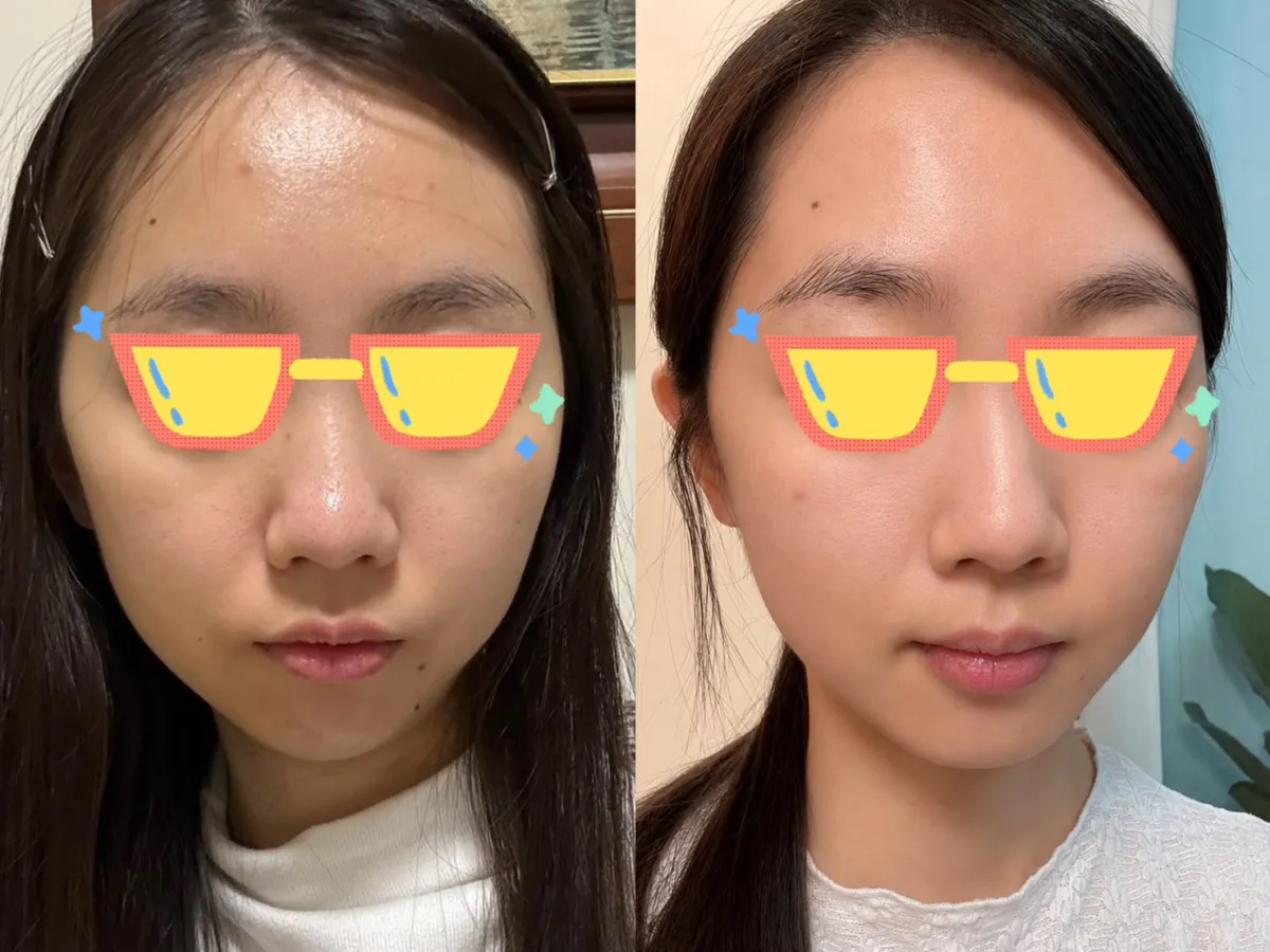 #分享 夫妻宮跟蘋果肌打薇貝拉很自然耶