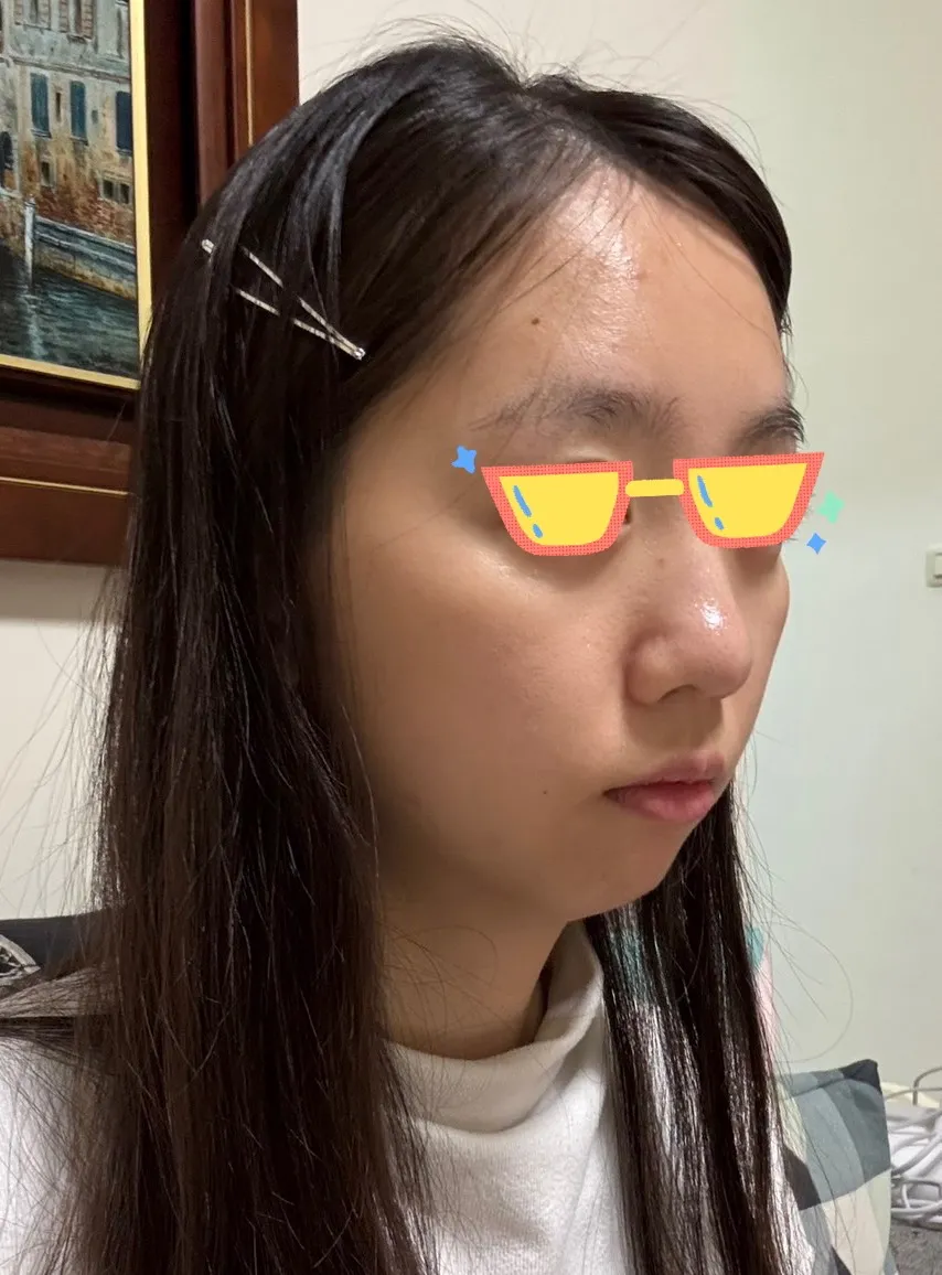 #分享 夫妻宮跟蘋果肌打薇貝拉很自然耶