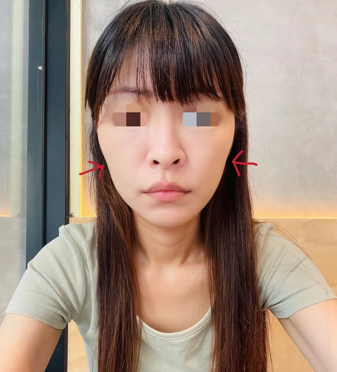 雙北打鳳凰電波有推薦的醫生嗎？很怕臉打到凹掉🥲