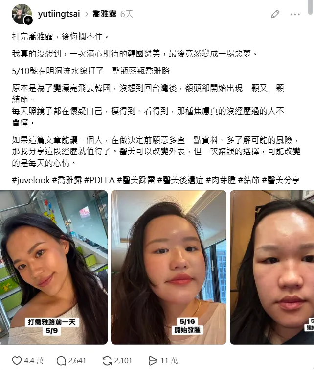 Threads上看到喬雅露失敗案例，這樣大家還敢打膠原蛋白增生劑嗎？