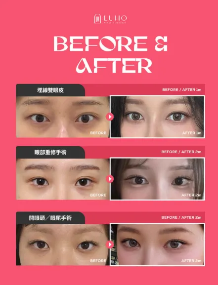 韓國整型 提眼肌/蘋果肌 有人去過LUHO嗎