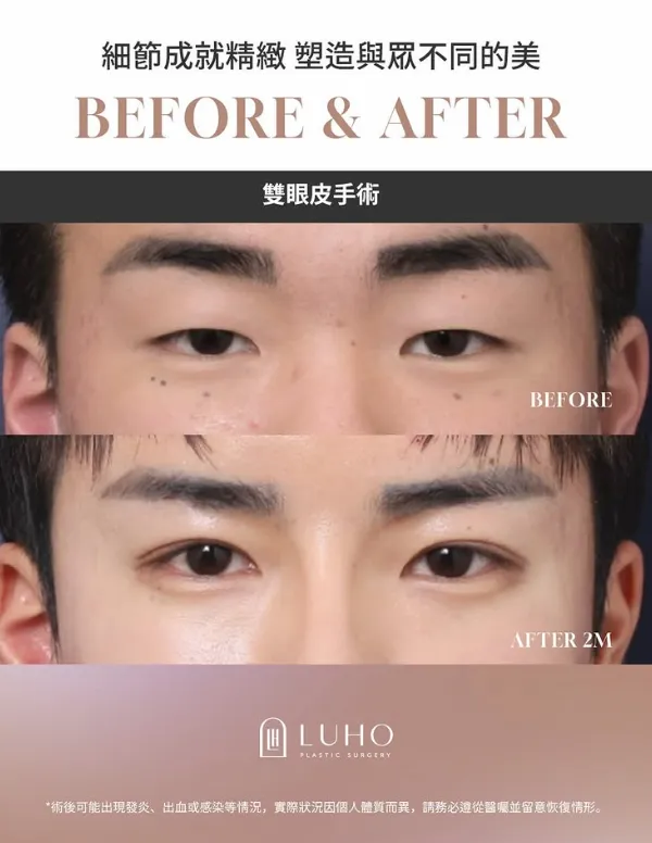 韓國整型 提眼肌/蘋果肌 有人去過LUHO嗎