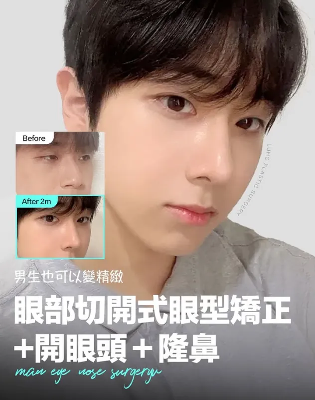韓國整型 提眼肌/蘋果肌 有人去過LUHO嗎