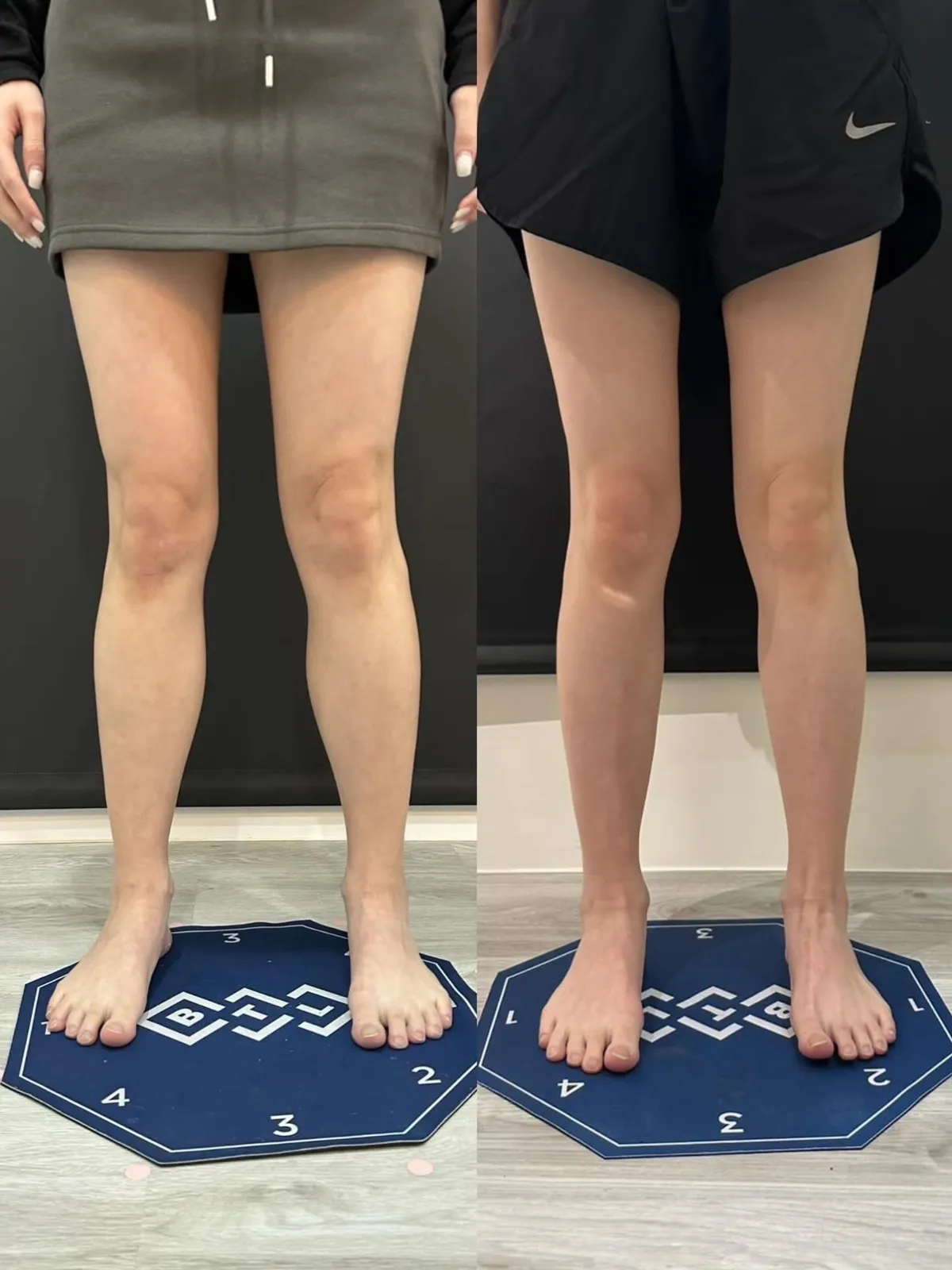 #分享 天氣變熱 肉毒瘦肩跟小腿肌超值得
