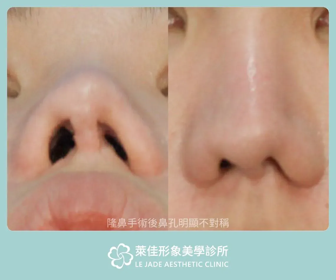隆鼻心得難道只有0分跟100分嗎?我不想重修鼻子