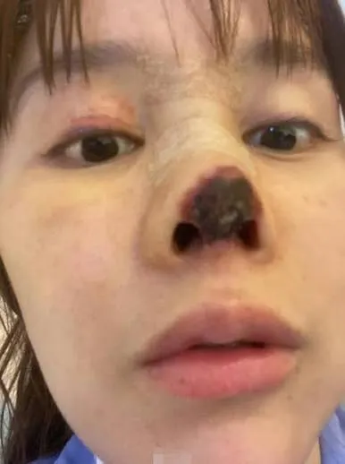 隆鼻心得難道只有0分跟100分嗎?我不想重修鼻子