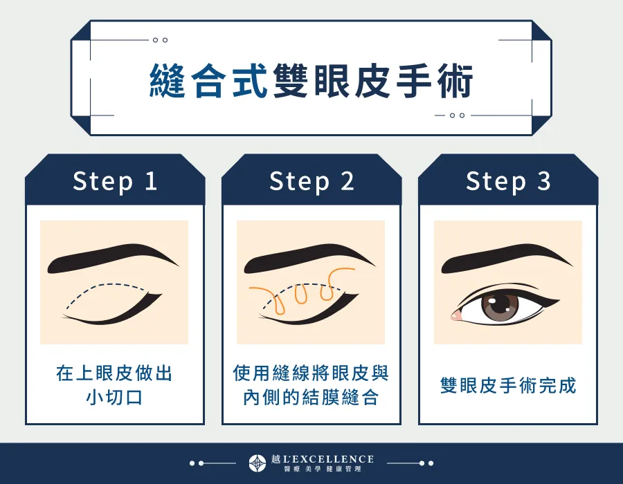 雙眼皮重修 到底要縫還是割