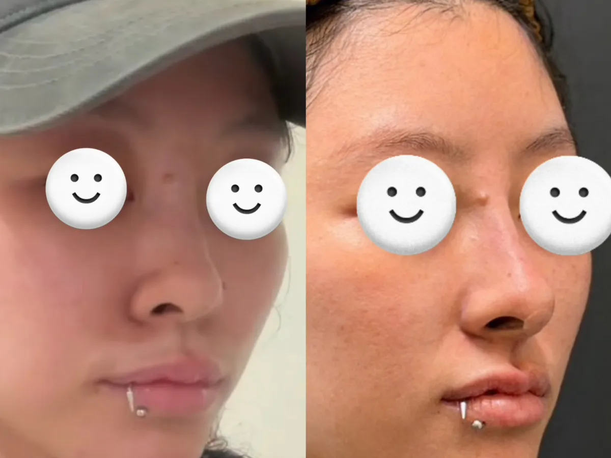 #分享 鼻雕真的可以讓鼻子更上一層樓