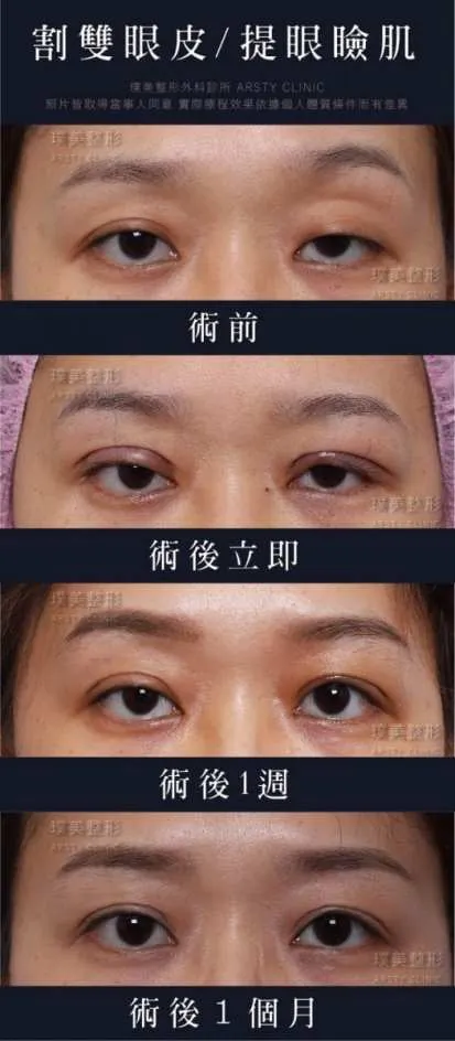提眼肌手術到底會不會很痛啊 有點被嚇到